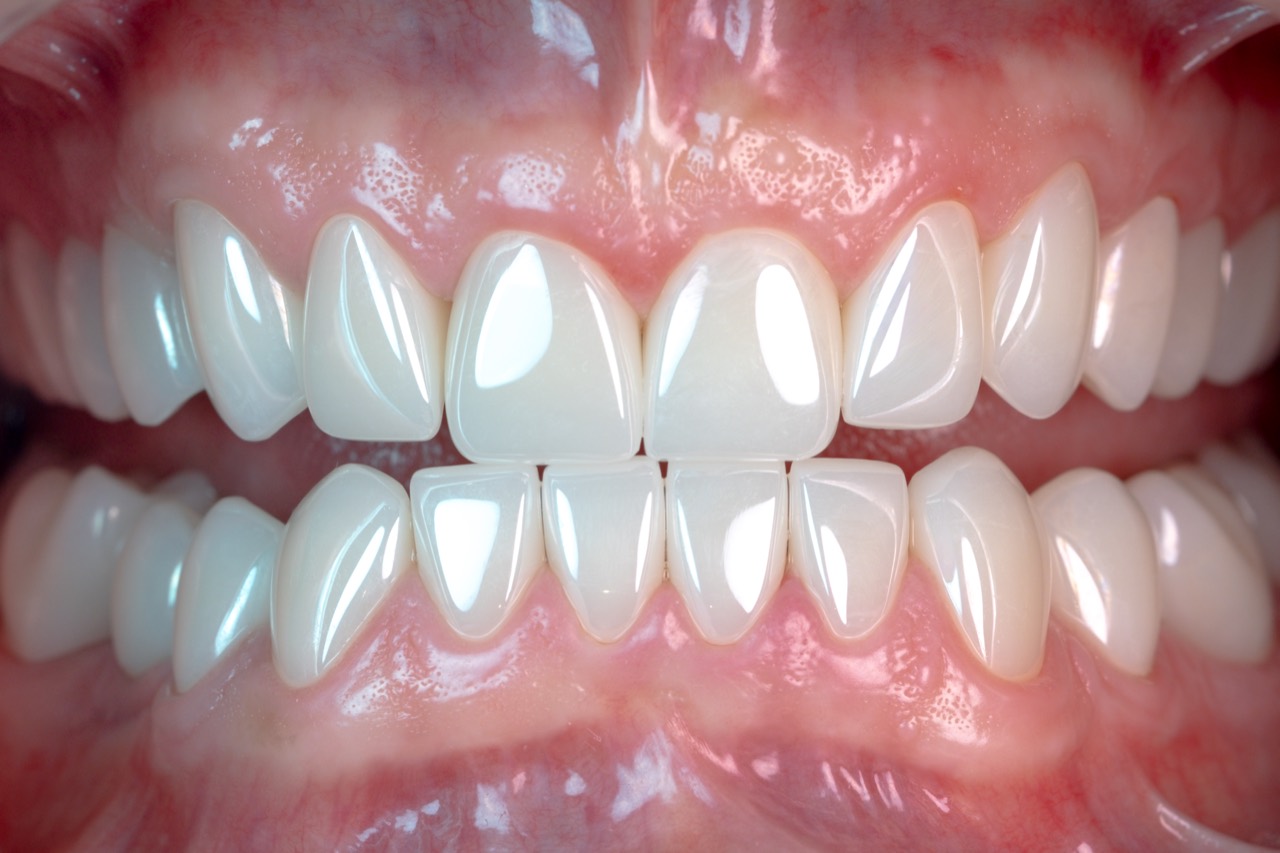 Ceramirr pearly white veneer sonrası — aynı ağız, orijinal bir Lovja vakası; yansıma iki çene boyunca kırılmadan akıyor