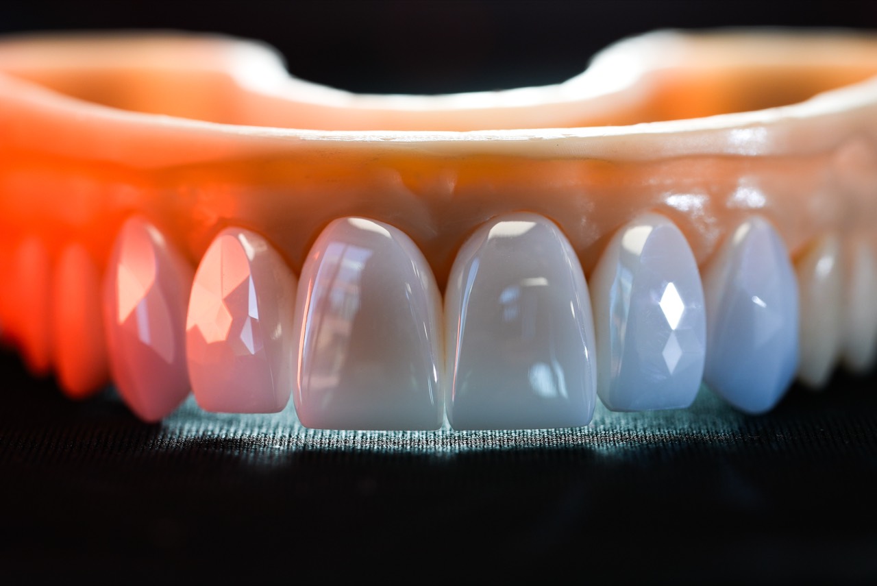 Modelde üst çene diamond cut veneer dizisi — renkli ışık yüzeyde çizgi çizgi kırılıyor