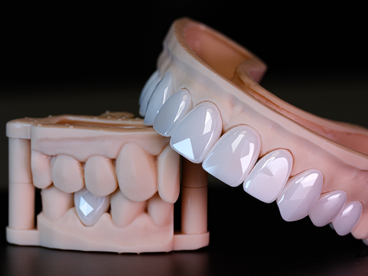 İki çenenin veneer dizileri yan yana — üst ve alt birlikte planlanır
